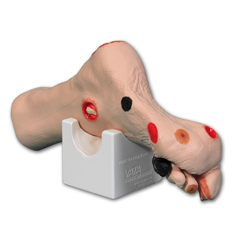 Wilma Wound Foot™